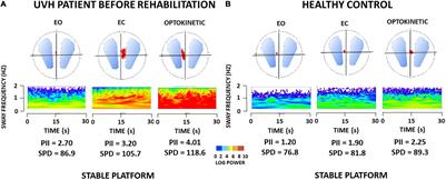 Posture Deficits and Recovery After Unilateral Vestibular Loss: Early Rehabilitation and Degree of Hypofunction Matter